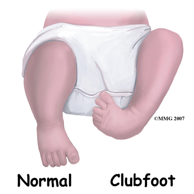 club foot treatment