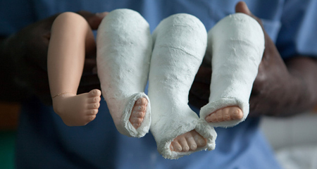 Clubfoot Treatment | Foot Doctor Southlake, Keller, Flower Mound, North  Richland Hills and Argyle, TX