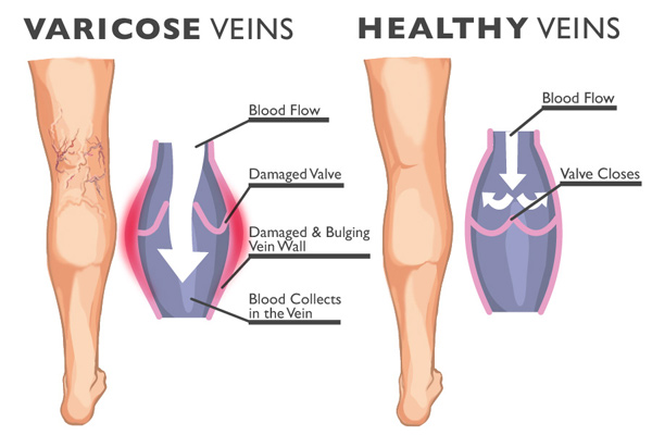 Varicose Veins Signs and Symptoms - Inovia Vein Specialty Center