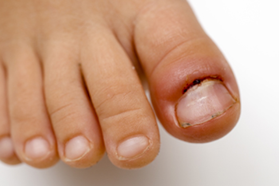 Your Toes Are Swollen — Is it Time to Worry?