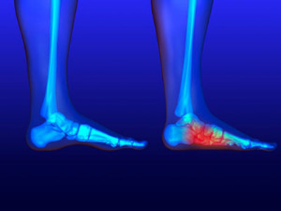 Running and Flat Feet