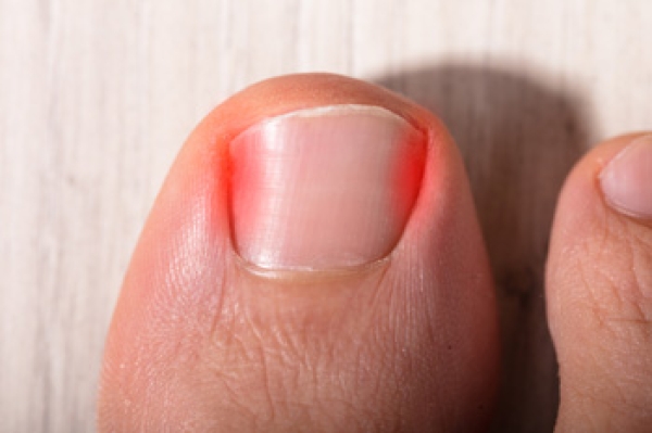 Ingrown Toenail for Watauga, TX